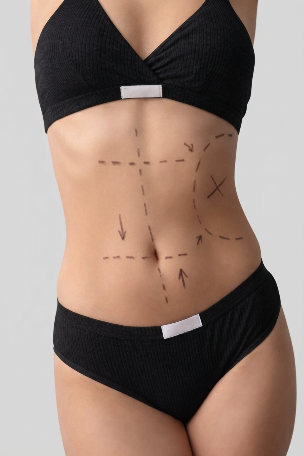Lipectomía Circular (Circunferencial) — SANTELLY Surgical Concierge