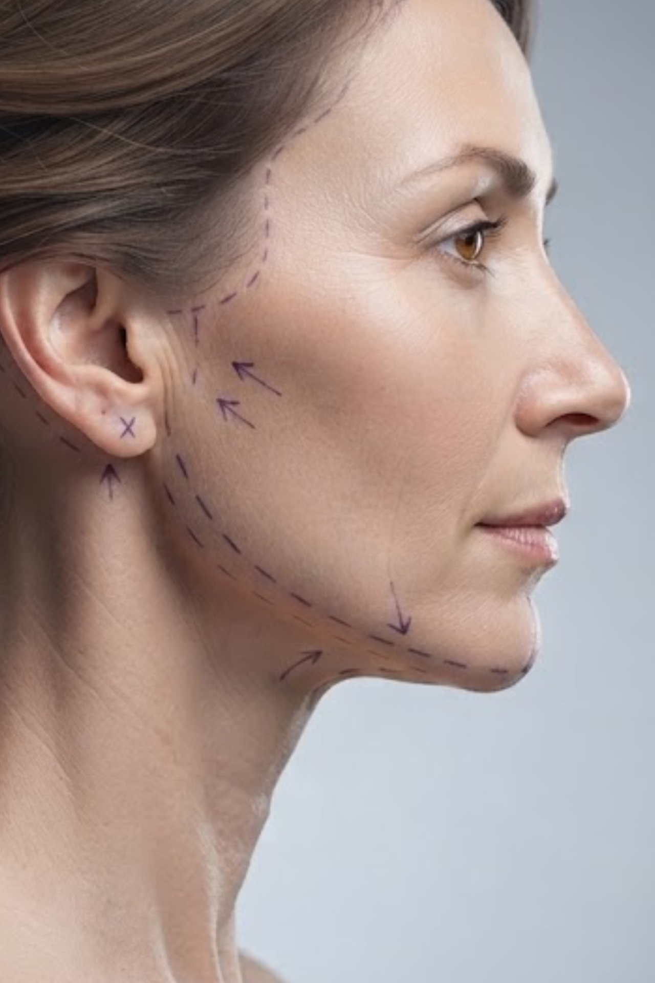 Facelift (Rhytidectomy) — SANTELLY Surgical Concierge